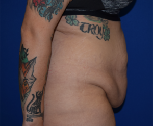 Panniculectomy Before and After Pictures Columbus, OH