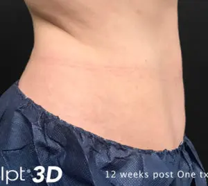 Cutera truSculpt 3D Before and After Pictures Columbus, OH