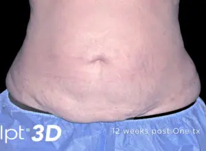 Cutera truSculpt 3D Before and After Pictures Columbus, OH