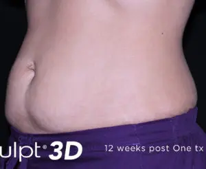 Cutera truSculpt 3D Before and After Pictures Columbus, OH