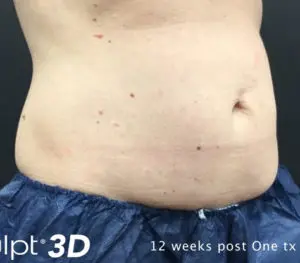 Cutera truSculpt 3D Before and After Pictures Columbus, OH