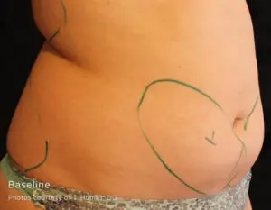Cutera truSculpt 3D Before and After Pictures Columbus, OH