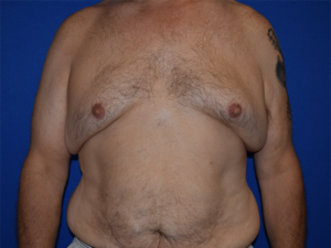 Gynecomastia Before and After Pictures Columbus, OH