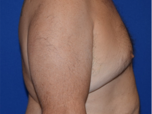 Gynecomastia Before and After Pictures Columbus, OH
