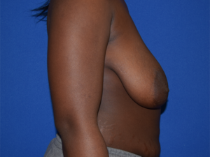 Breast Reduction Before and After Pictures Columbus, OH