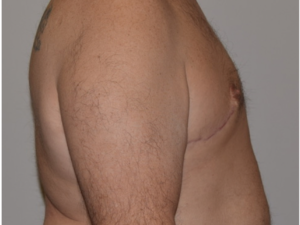 Gynecomastia Before and After Pictures Columbus, OH