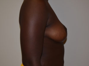 Breast Reduction Before and After Pictures Columbus, OH