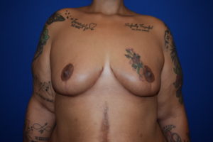 Breast Reduction Before and After Pictures Columbus, OH