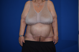 Panniculectomy Before and After Pictures Columbus, OH