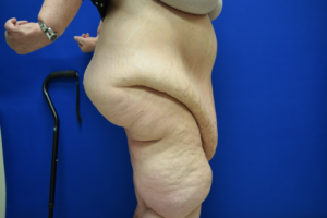 Panniculectomy Before and After Pictures Columbus, OH