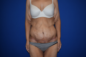Panniculectomy Before and After Pictures Columbus, OH