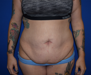 Panniculectomy Before and After Pictures Columbus, OH