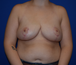 Breast Reduction Before and After Pictures Columbus, OH