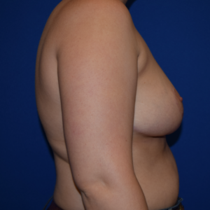 Breast Reduction Before and After Pictures Columbus, OH