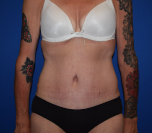 Tummy Tuck Before and After Pictures Columbus, OH