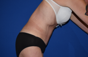 Tummy Tuck Before and After Pictures Columbus, OH