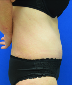 Tummy Tuck Before and After Pictures Columbus, Dublin, OH