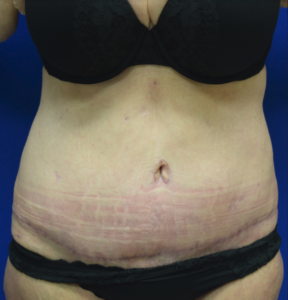 Tummy Tuck Before and After Pictures Columbus, OH