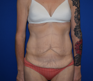 Tummy Tuck Before and After Pictures Columbus, OH