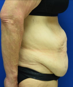 Tummy Tuck Before and After Pictures Columbus, OH