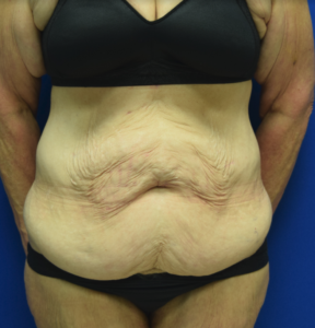 Tummy Tuck Before and After Pictures Columbus, OH