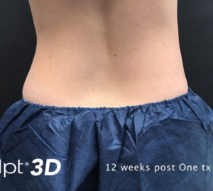 Cutera truSculpt 3D Before and After Pictures Columbus, OH