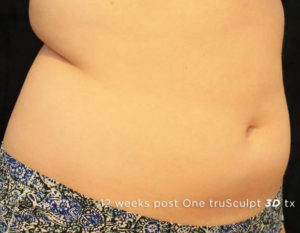 Cutera truSculpt 3D Before and After Pictures Columbus, OH