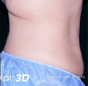 Cutera truSculpt 3D Before and After Pictures Columbus, OH