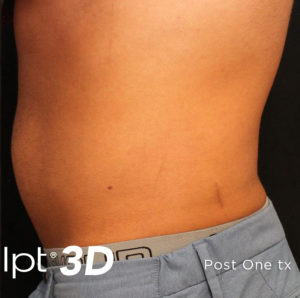 Cutera truSculpt 3D Before and After Pictures Columbus, OH