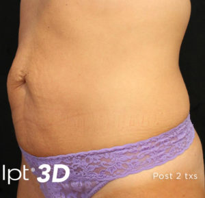 Cutera truSculpt 3D Before and After Pictures Columbus, OH