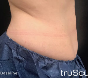 Cutera truSculpt 3D Before and After Pictures Columbus, OH