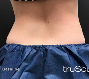 Cutera truSculpt 3D Before and After Pictures Columbus, OH