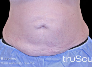Cutera truSculpt 3D Before and After Pictures Columbus, OH