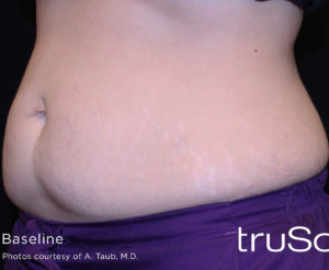 Cutera truSculpt 3D Before and After Pictures Columbus, OH