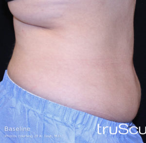 Cutera truSculpt 3D Before and After Pictures Columbus, OH