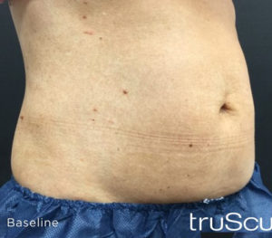 Cutera truSculpt 3D Before and After Pictures Columbus, OH