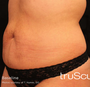 Cutera truSculpt 3D Before and After Pictures Columbus, OH