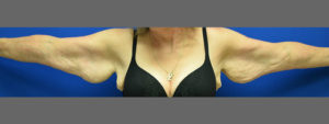 Brachioplasty Before and After Pictures Columbus, OH