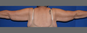 Brachioplasty Before and After Pictures Columbus, OH