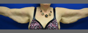 Brachioplasty Before and After Pictures Columbus, OH