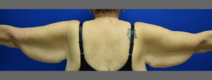 Brachioplasty Before and After Pictures Columbus, OH
