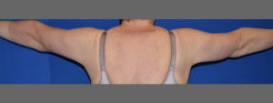 Brachioplasty Before and After Pictures Columbus, OH