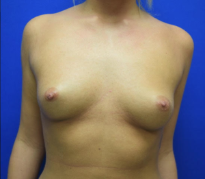 Breast Augmentation Before and After Pictures Columbus, OH