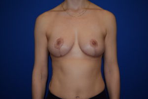 Breast Reduction Before and After Pictures Columbus, OH