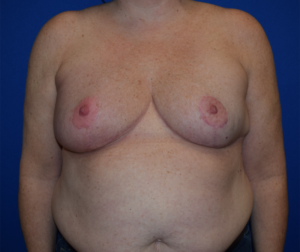 Breast Reduction Before and After Pictures Columbus, OH