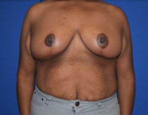 Breast Reduction Before and After Pictures Columbus, OH