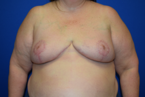 Breast Reduction Before and After Pictures Columbus, OH