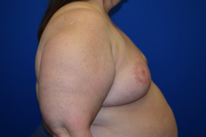 Breast Reduction Before and After Pictures Columbus, OH