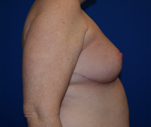 Breast Reduction Before and After Pictures Columbus, OH