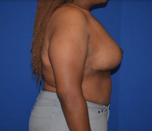 Breast Reduction Before and After Pictures Columbus, OH